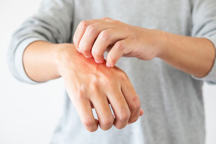 Dị ứng vòng trầm hương: Nguyên nhân, cách khắc phục bị ngứa 4 dị ứng vòng trầm hương